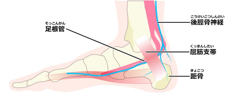 足根管,イメージ