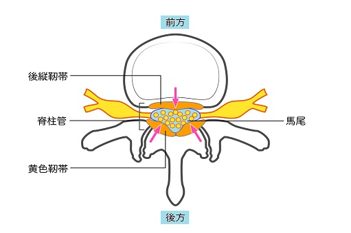 脊柱管狭窄症,イメージ